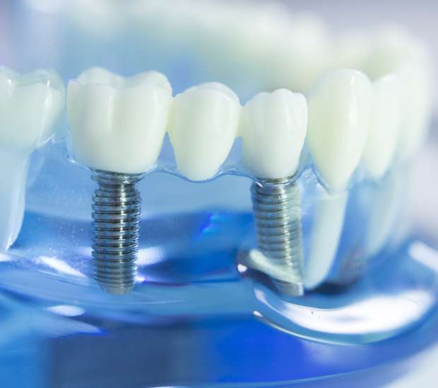 Potomac Dental Implants